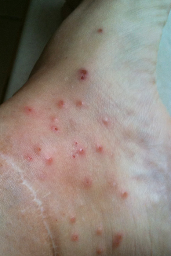 ant bite rash #9